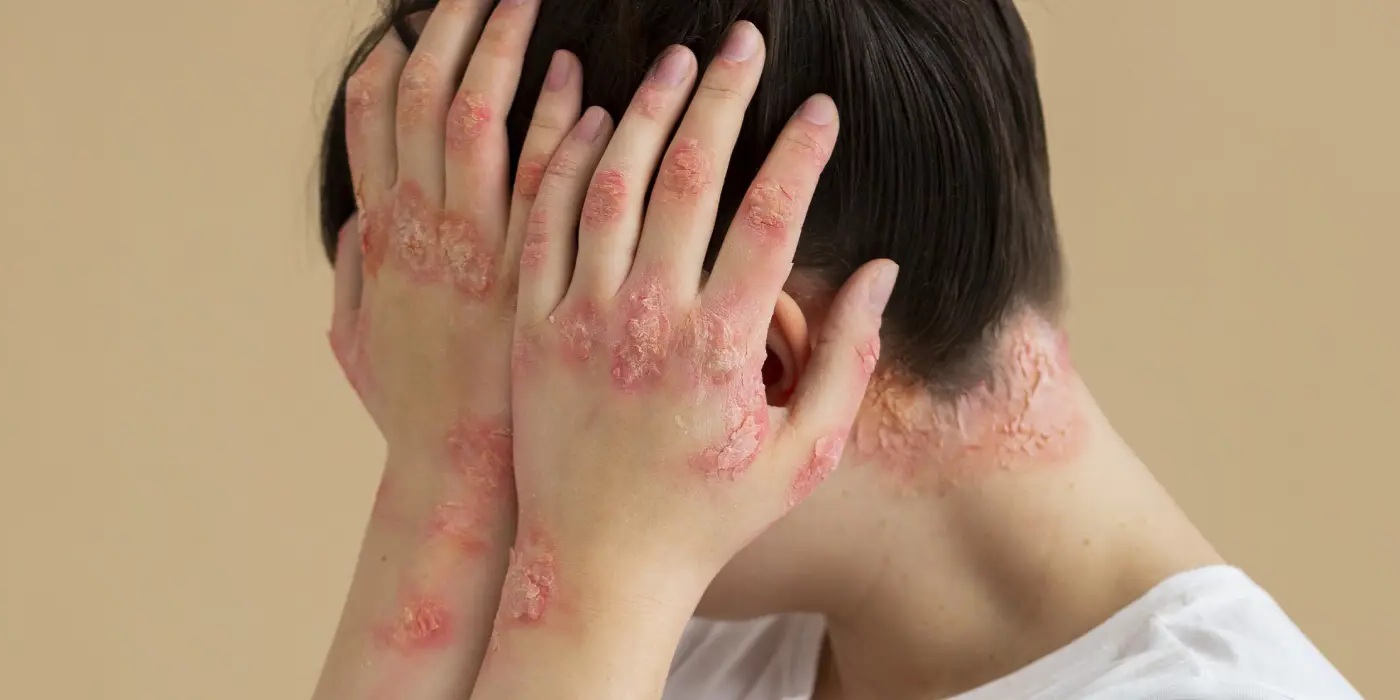 32 Fatti Su Eczema