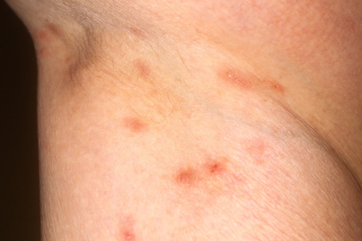 35 Fatti Su Scabbia