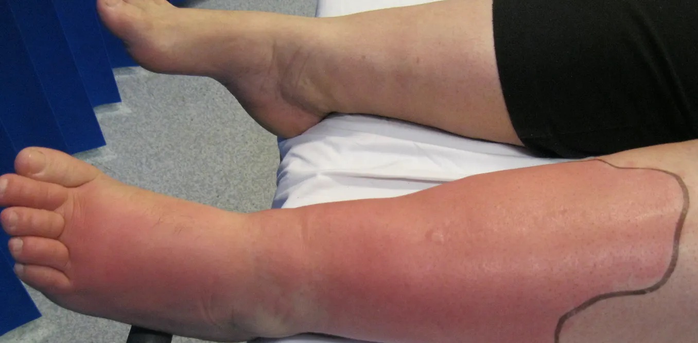 37 Fatti Su Cellulite